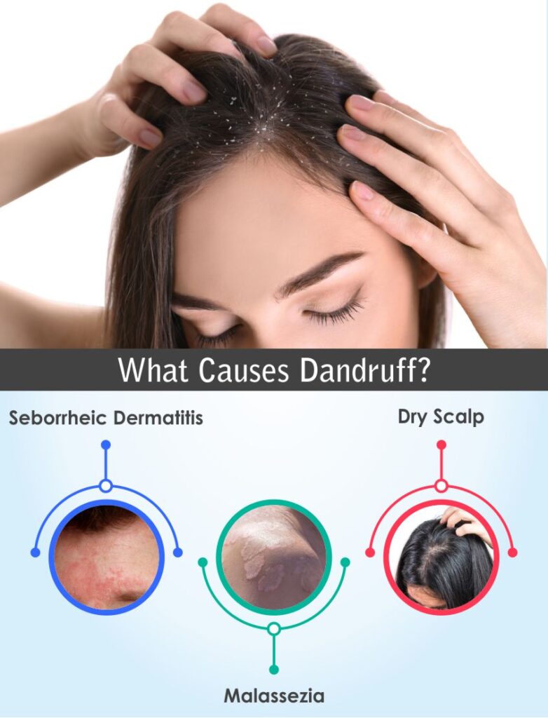 Get Rid of Dandruff